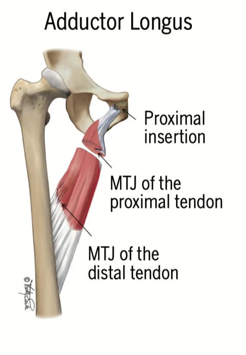 Schmerzen in der Leiste - Adductor Longus Sehne