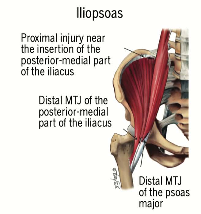 Schmerzen in der Leiste - Iliopsoas