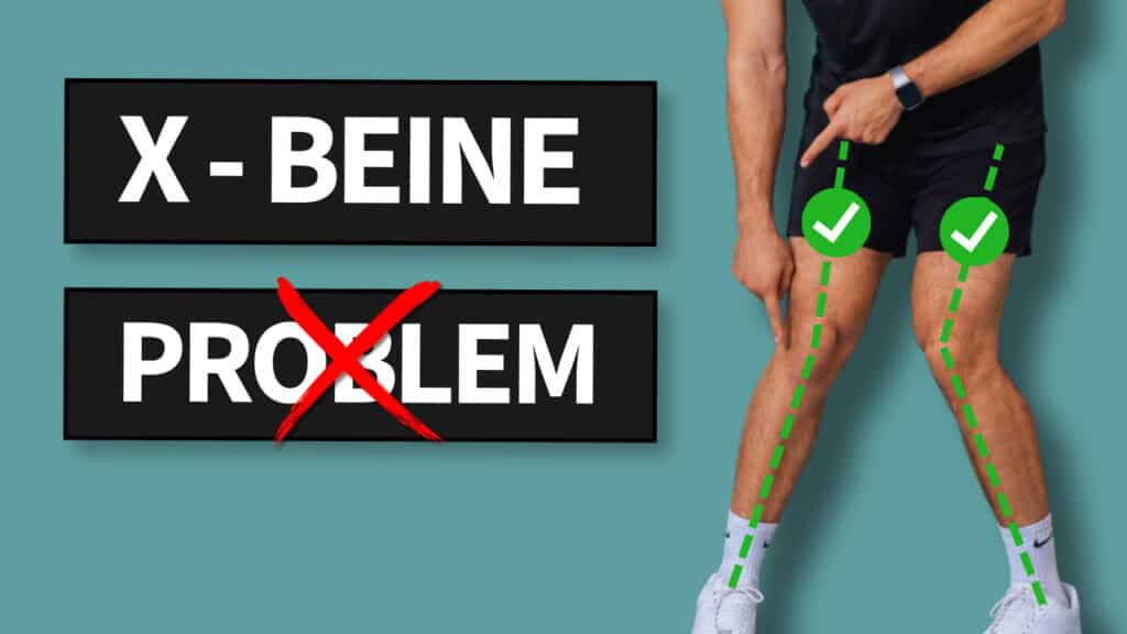 Mann steht mit nach innen gerichteten Knien (X-Beine), grüne gestrichelte Beinachsen-Linien mit Häkchen, daneben der Text „X-Beine“ und das durchgestrichene Wort „Problem“